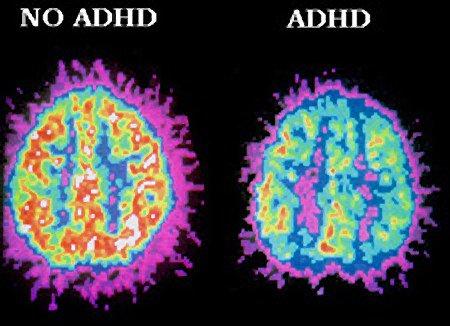 What struggles do people with ADHD face? Expert answers & advice.